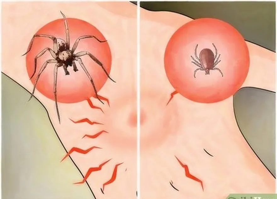 ステップ3ドン't confuse tick bites as spider bites.