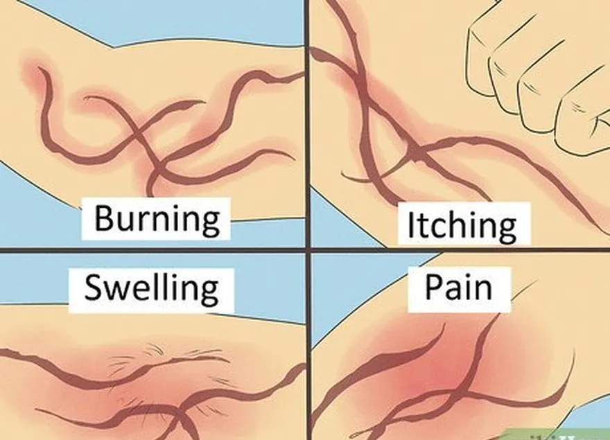 ステップ3燃焼、刺す、かゆみ、腫れ、痛みは一般的な症状です。