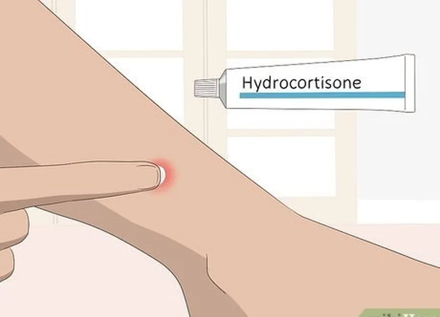 ステップ3は、かゆみを和らげるために局所軟膏を適用します。